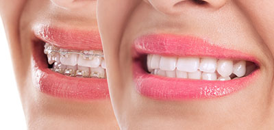 Benecchi Dental Group | Root Canals, iTero   Intraoral Scanner and Invisalign reg 