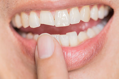 Benecchi Dental Group | Periodontal Treatment, Digital Radiography and Invisalign reg 