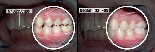 Benecchi Dental Group | Crowns  amp  Caps, Dental Bridges and Periodontal Treatment