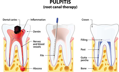 Benecchi Dental Group | Root Canals, Emergency Treatment and Dental Cleanings