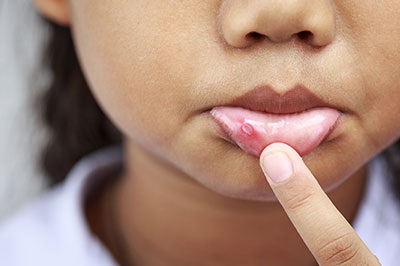 Benecchi Dental Group | Crowns  amp  Caps, Pediatric Dentistry and iTero   Intraoral Scanner