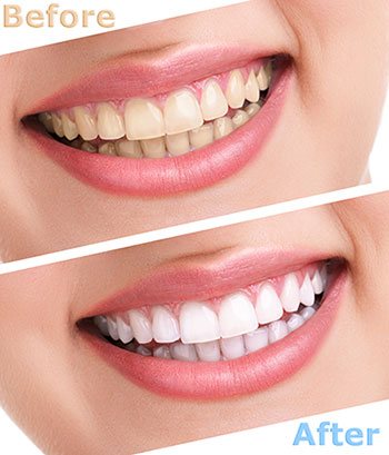 Benecchi Dental Group | Dental Fillings, Extractions and Crowns  amp  Caps