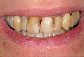 Benecchi Dental Group | Crowns  amp  Caps, Cosmetic Dentistry and Dentures